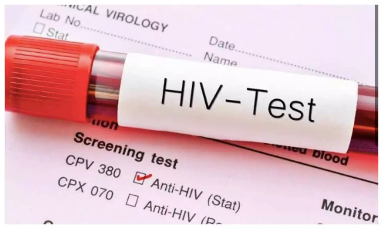 HIV Causes and Symptoms