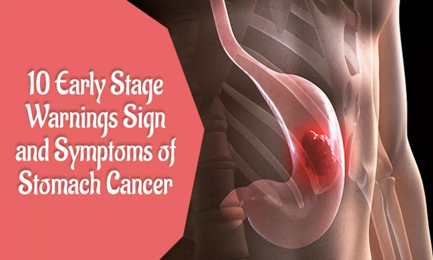 stomach cancer