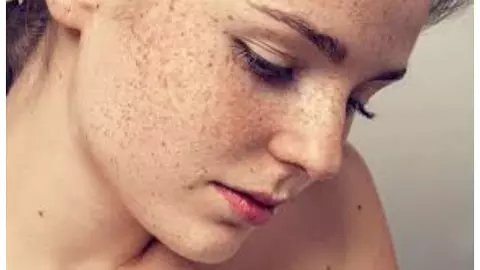 Melasma Melasma