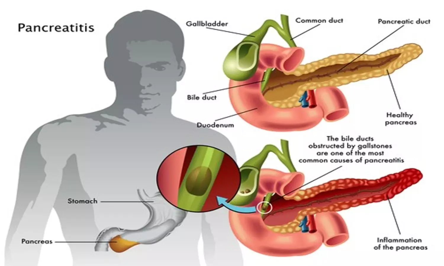 Pancreatitis