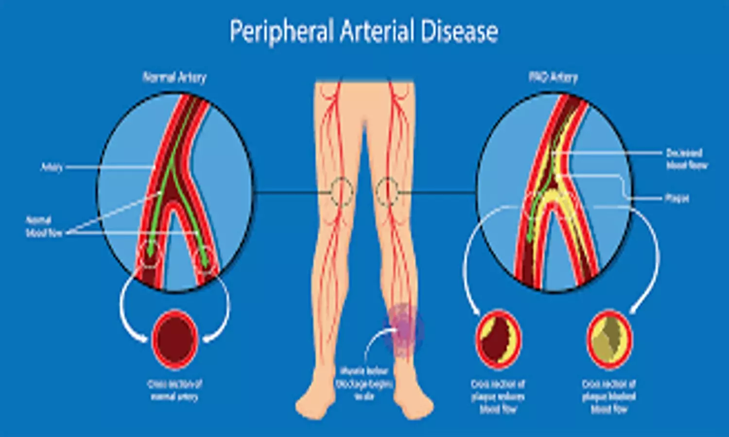 Peripheral Symptoms