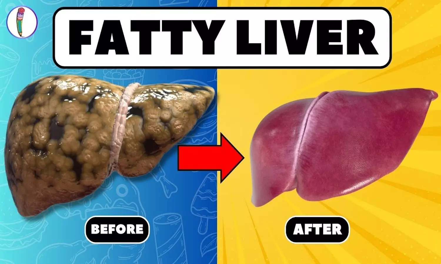 Bad Foods for Fatty Liver