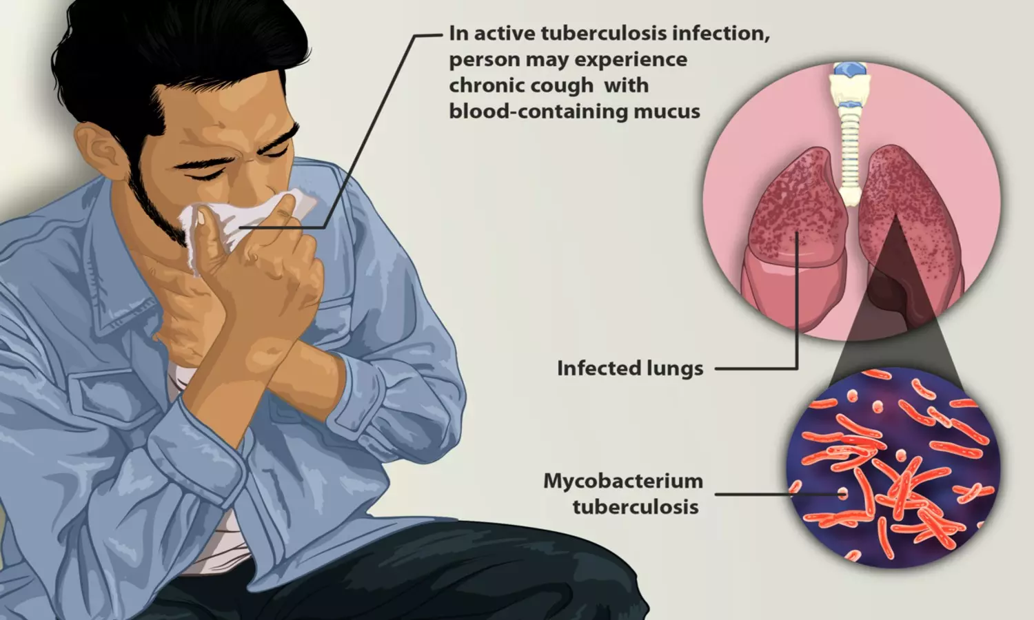 Tuberculosis