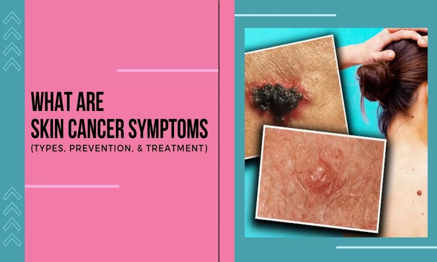 Skin Cancer Symptoms
