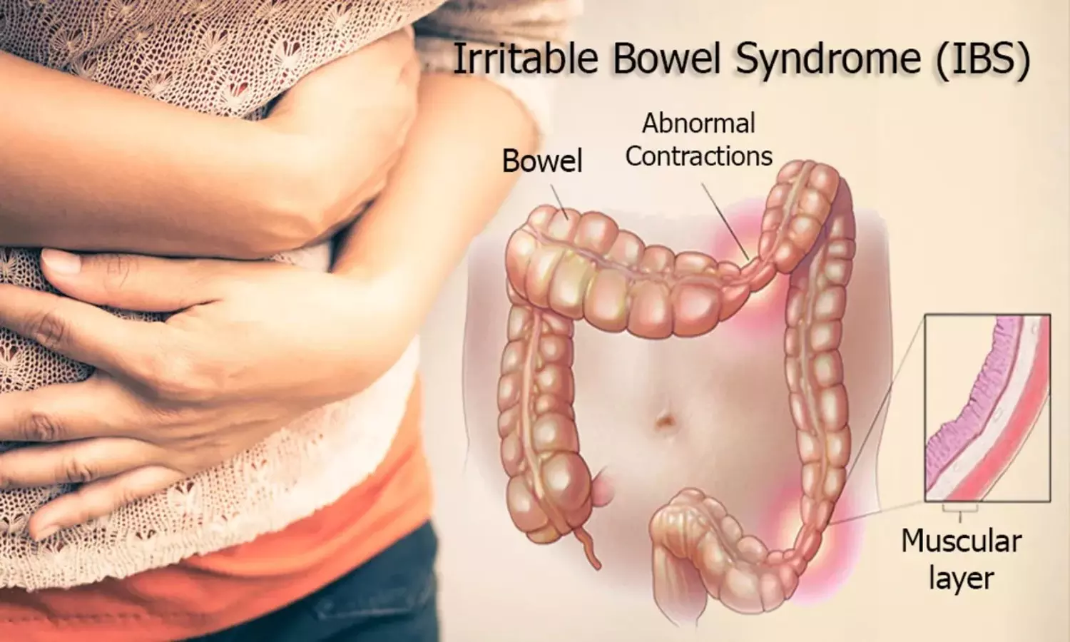 Irritable Bowel Syndrome