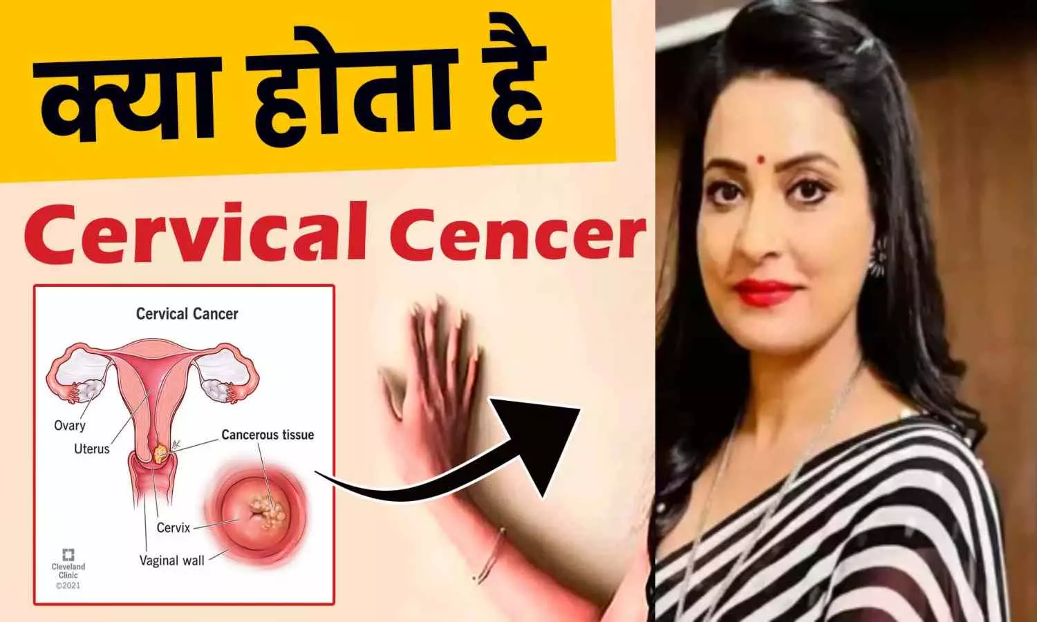 Cervical Cancer