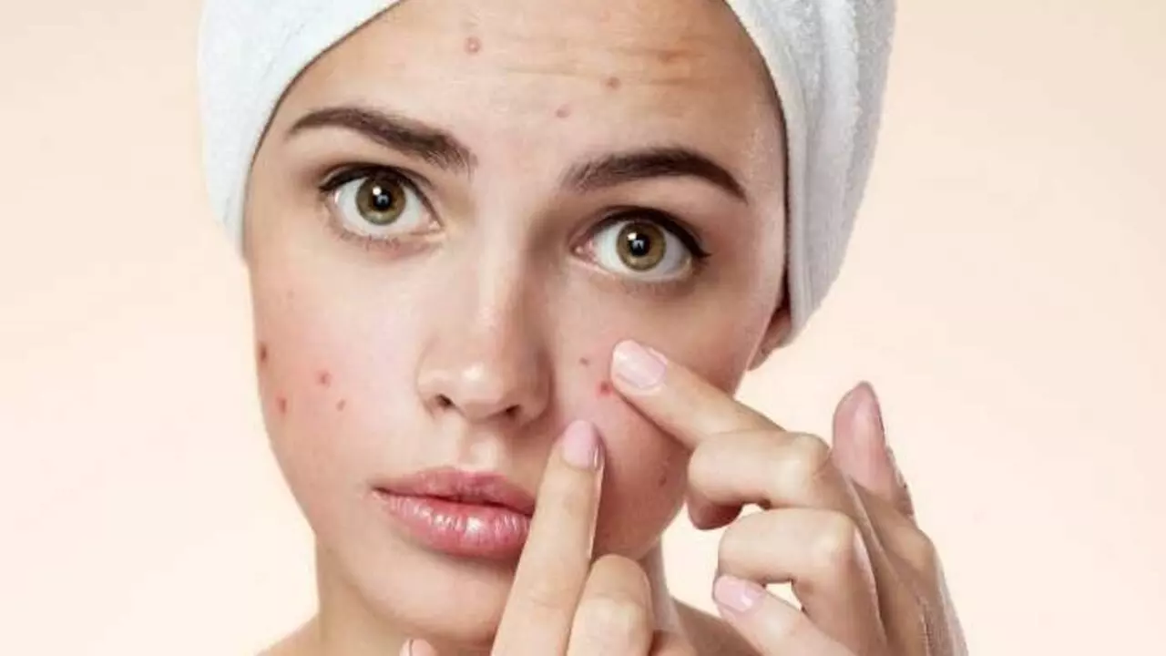 Pimples Remedies: पेट की गर्मी से भी होते हैं मुहांसे, यहां जानें उपाय
