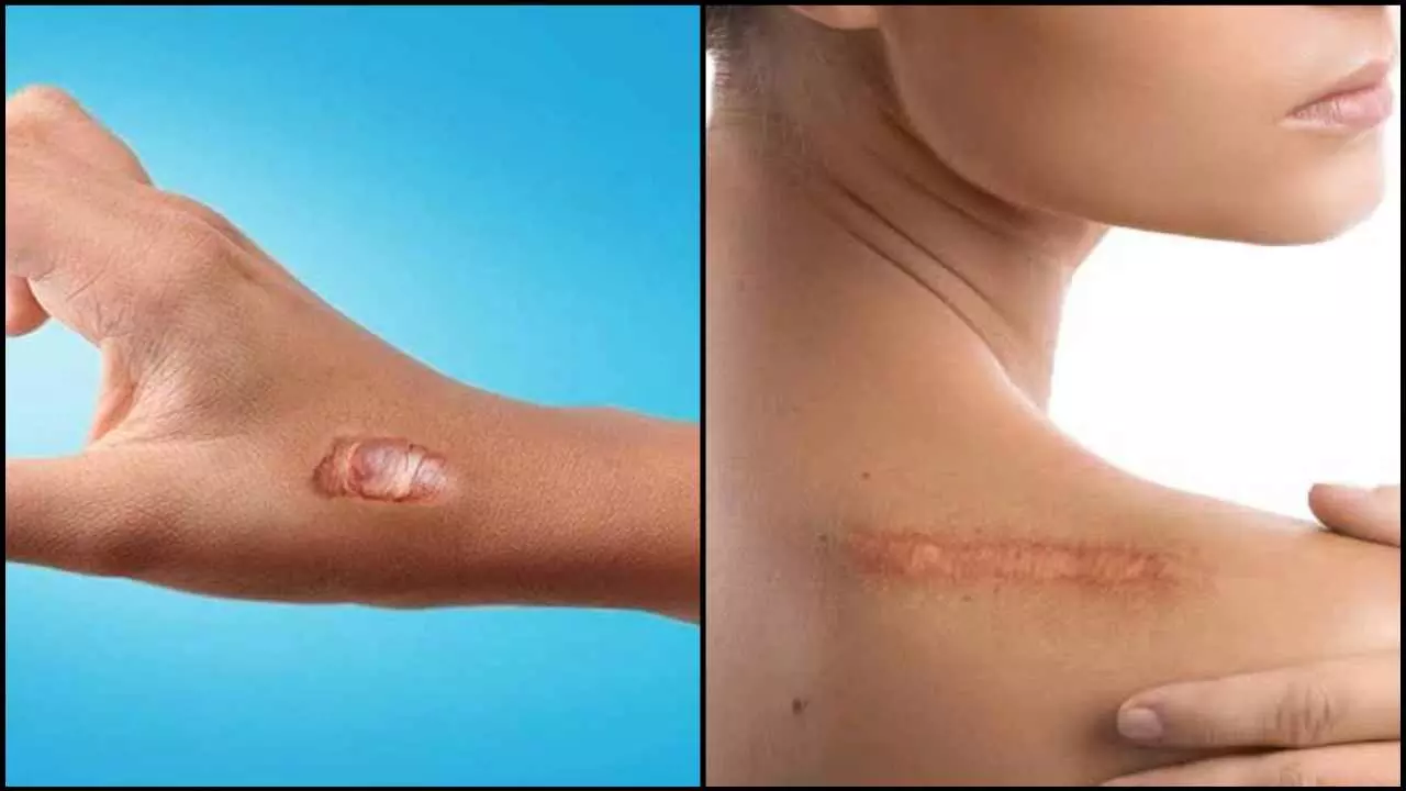 Home Remedies For Burning Marks