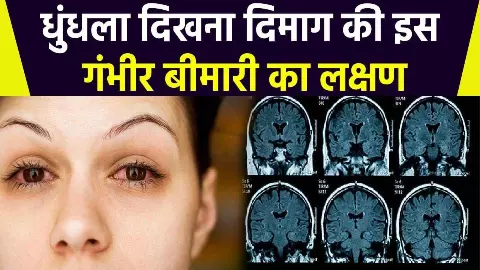 Brain Tumors in Youngsters Brain Tumors in Youngsters