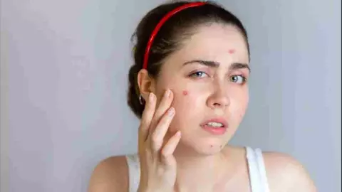 Pimples On Face Pimples On Face