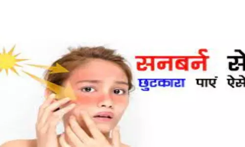 Home Remedies for Sunburn