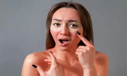 Sunburn: सनबर्न में 100 प्रतिशत कारगर हैं ये घरेलू उपाय, देंगे तुरंत राहत