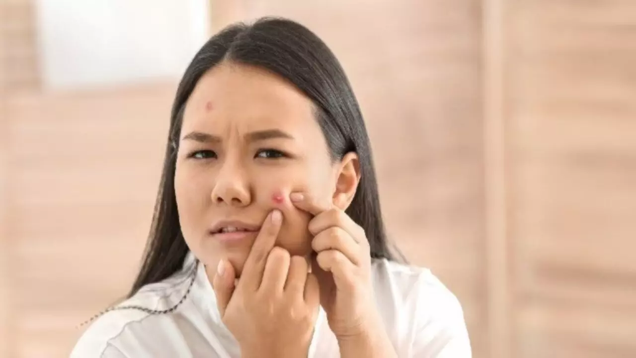 Pimples Ke Upay: रातभर में गायब हो जाएंगे पिंपल्स, सोने से पहले करें ये उपाय