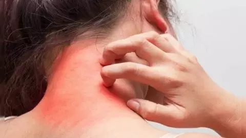 Rashes Ke Gharelu Upay: बारिश के कारण हो गई है खुजली और रैशेज, ये घरेलू उपाय करेंगे छुट्टी