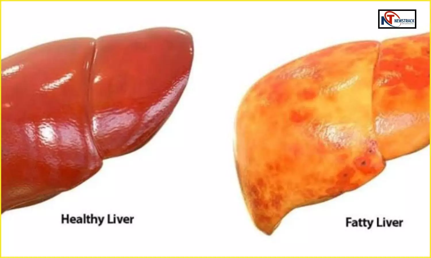 Hardoi Medical College Fatty Liver Problem