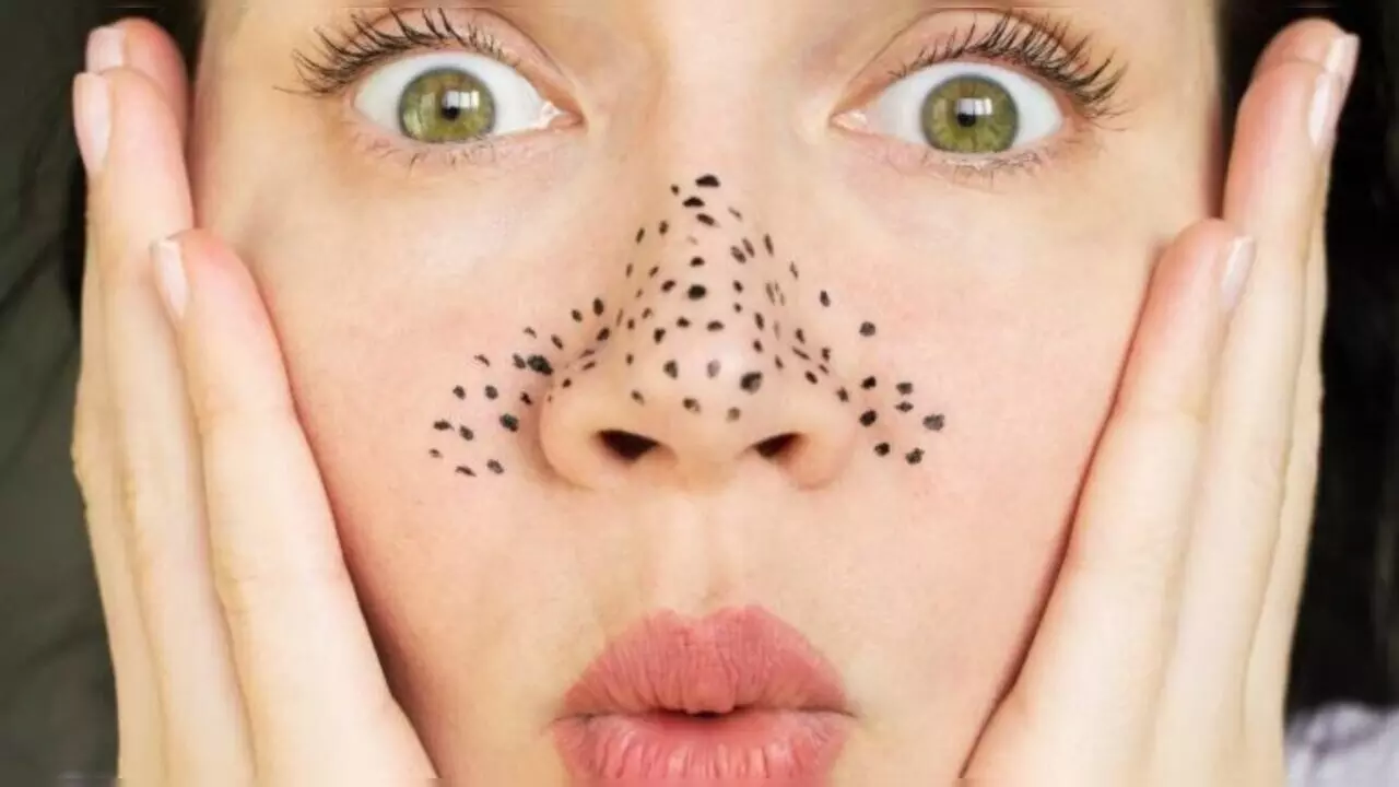 Blackheads Remedies: चेहरे से नहीं जा रहे जिद्दी ब्लैकहेड्स, हटाने के लिए आजमाएं ये घरेलू उपाय