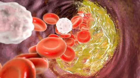 Cholesterol Kaise Kam Kare: बढ़ा हुआ कोलेस्ट्रॉल कैसे घटाएं, यहां जान लें कुछ असरदार तरीके Cholesterol Kaise Kam Kare: बढ़ा हुआ कोलेस्ट्रॉल कैसे घटाएं, यहां जान लें कुछ असरदार तरीके