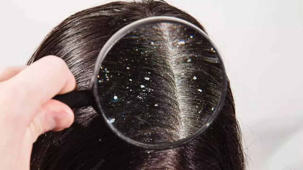 Dandruff Treatment: सर्दियां शुरू होते ही होने लगी है डैंड्रफ की समस्या? जानें इससे बचाव का बेस्ट तरीका