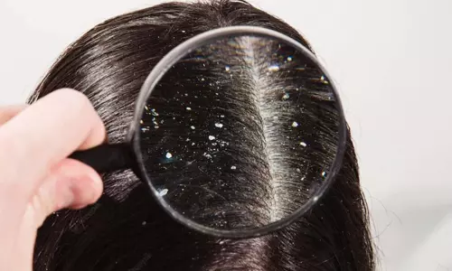 Dandruff Treatment: सर्दियां शुरू होते ही होने लगी है डैंड्रफ की समस्या? जानें इससे बचाव का बेस्ट तरीका