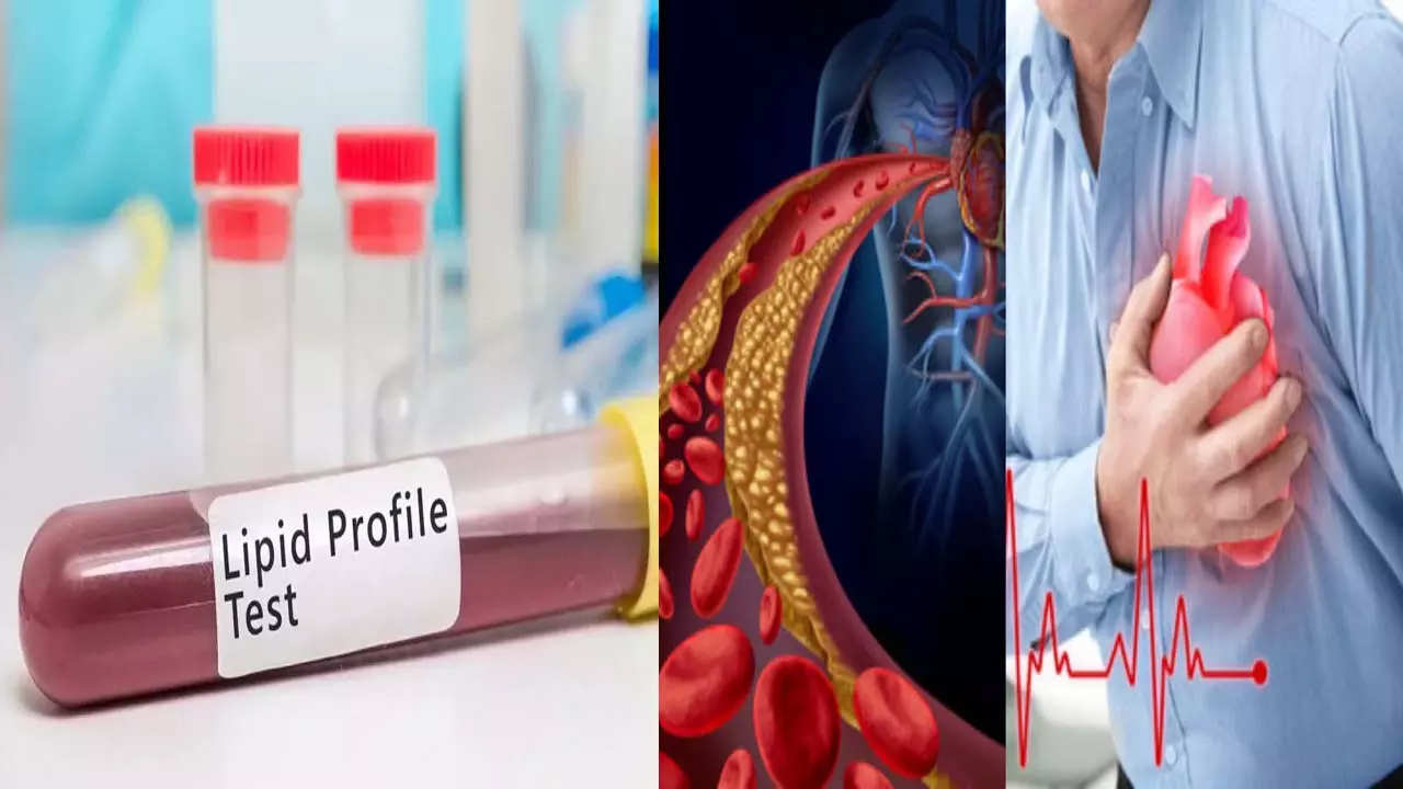 LIPID PROFILE