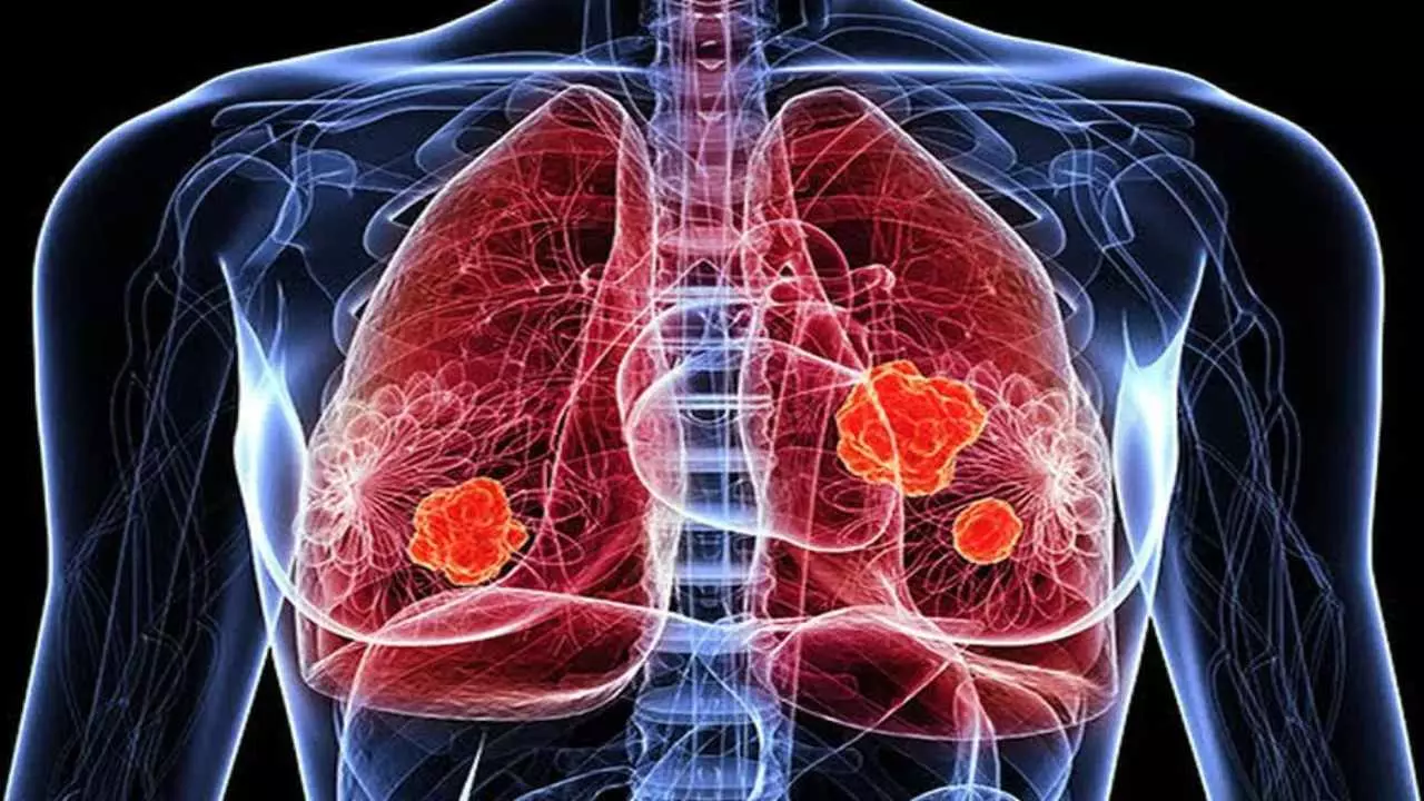 lung cancer