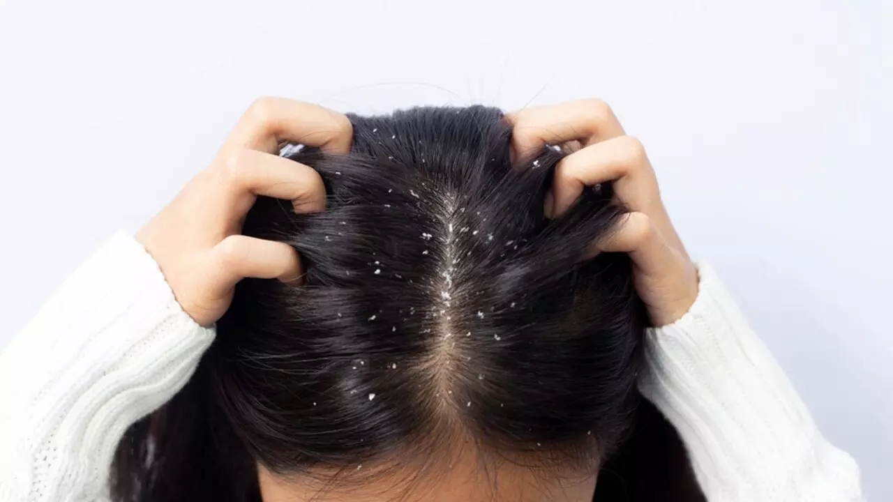 Hair Care Tips: बालों से डैंड्रफ को हटाना है तो ट्राई करें ये नेचुरल हेयर मास्क, एक बार में ही दिखेगा फर्क