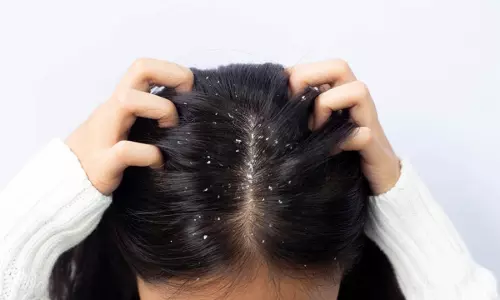 Hair Care Tips: बालों से डैंड्रफ को हटाना है तो ट्राई करें ये नेचुरल हेयर मास्क, एक बार में ही दिखेगा फर्क