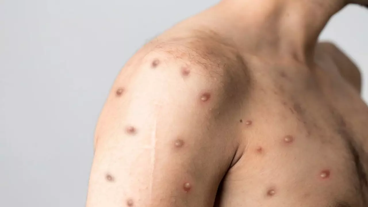 monkeypox found in deoria