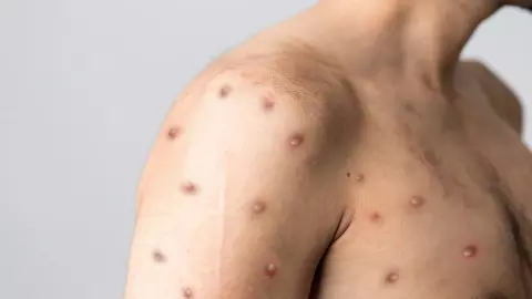 monkeypox found in deoria