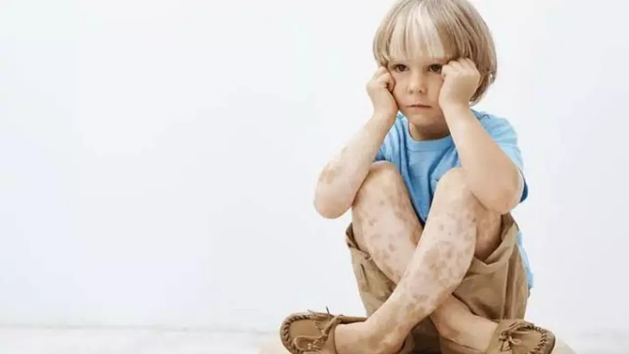 white patches on children face