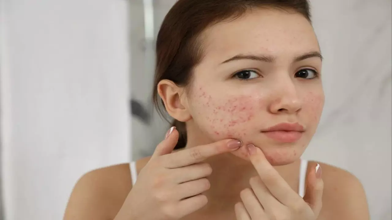 Face Pimples Reason