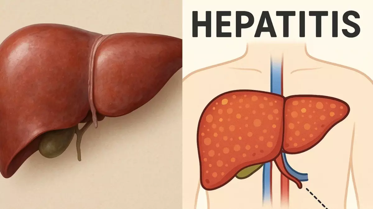 World Hepatitis Day 2025