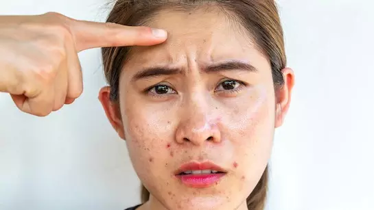 Virus That Can Trigger Skin Cancer