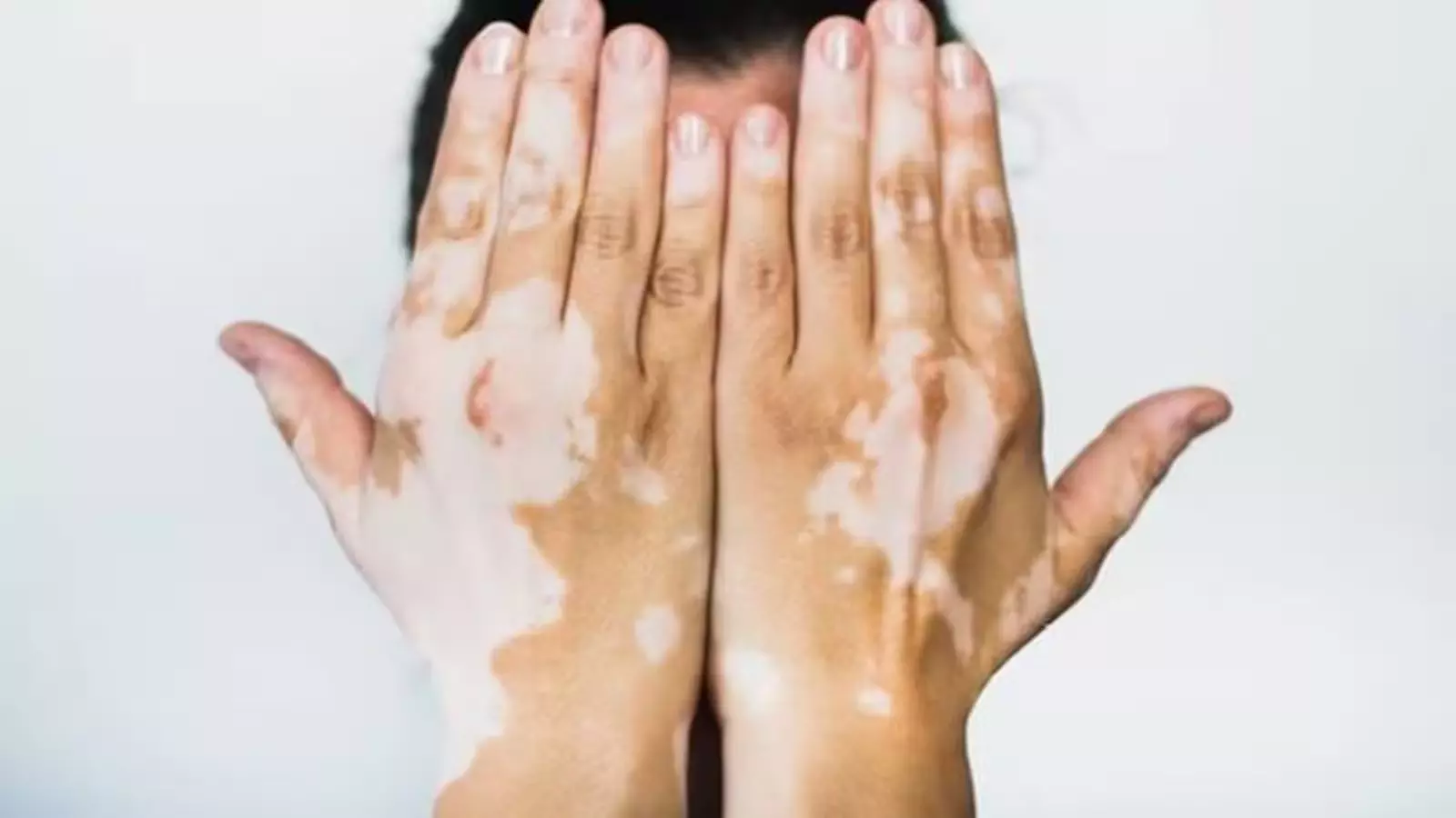 Causes, Symptoms, and Treatment of Vitiligo