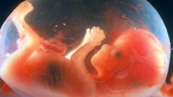 Fetus in Fetu case In Haryana
