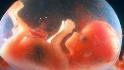 Fetus in Fetu case In Haryana Fetus in Fetu case In Haryana