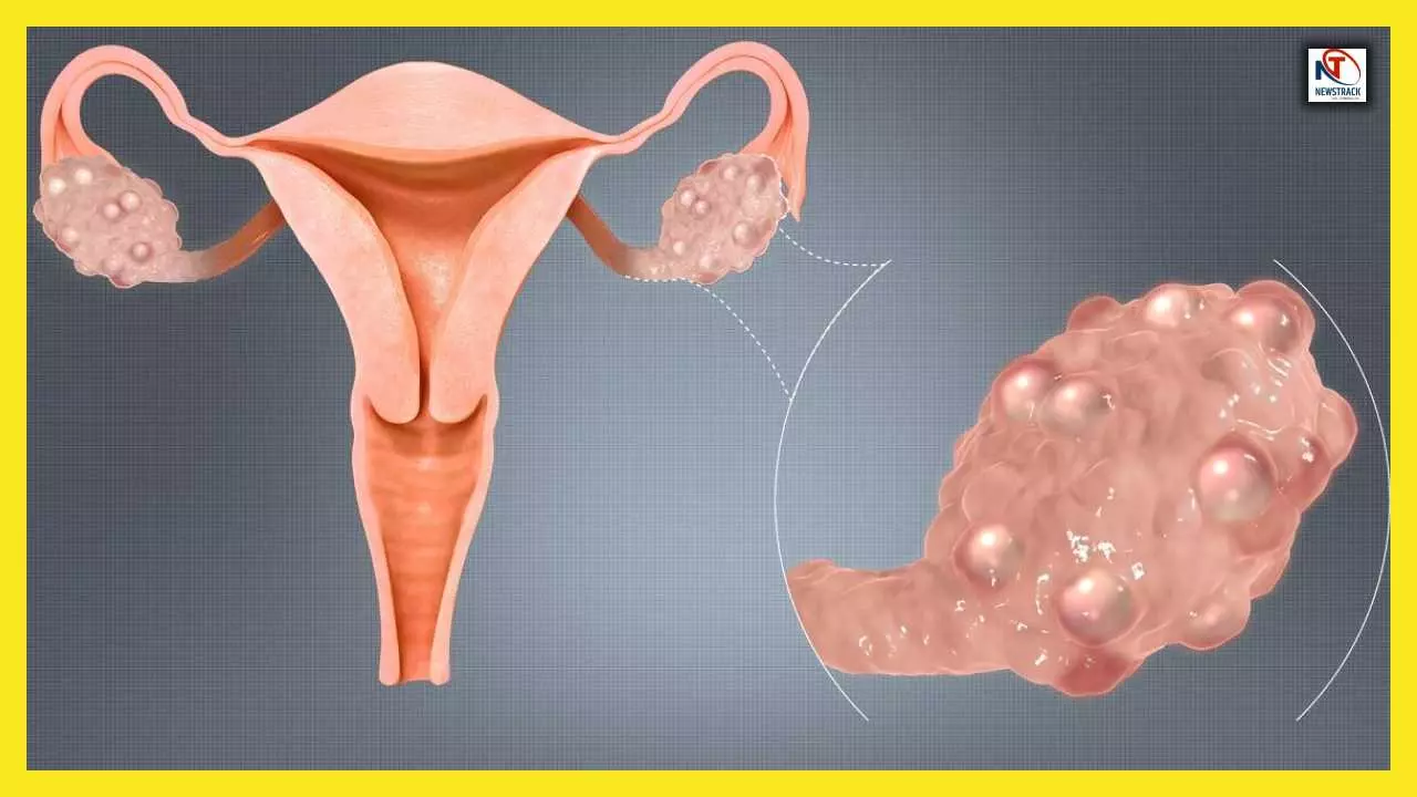 What is PCOS and PCOD Symptoms Treatment