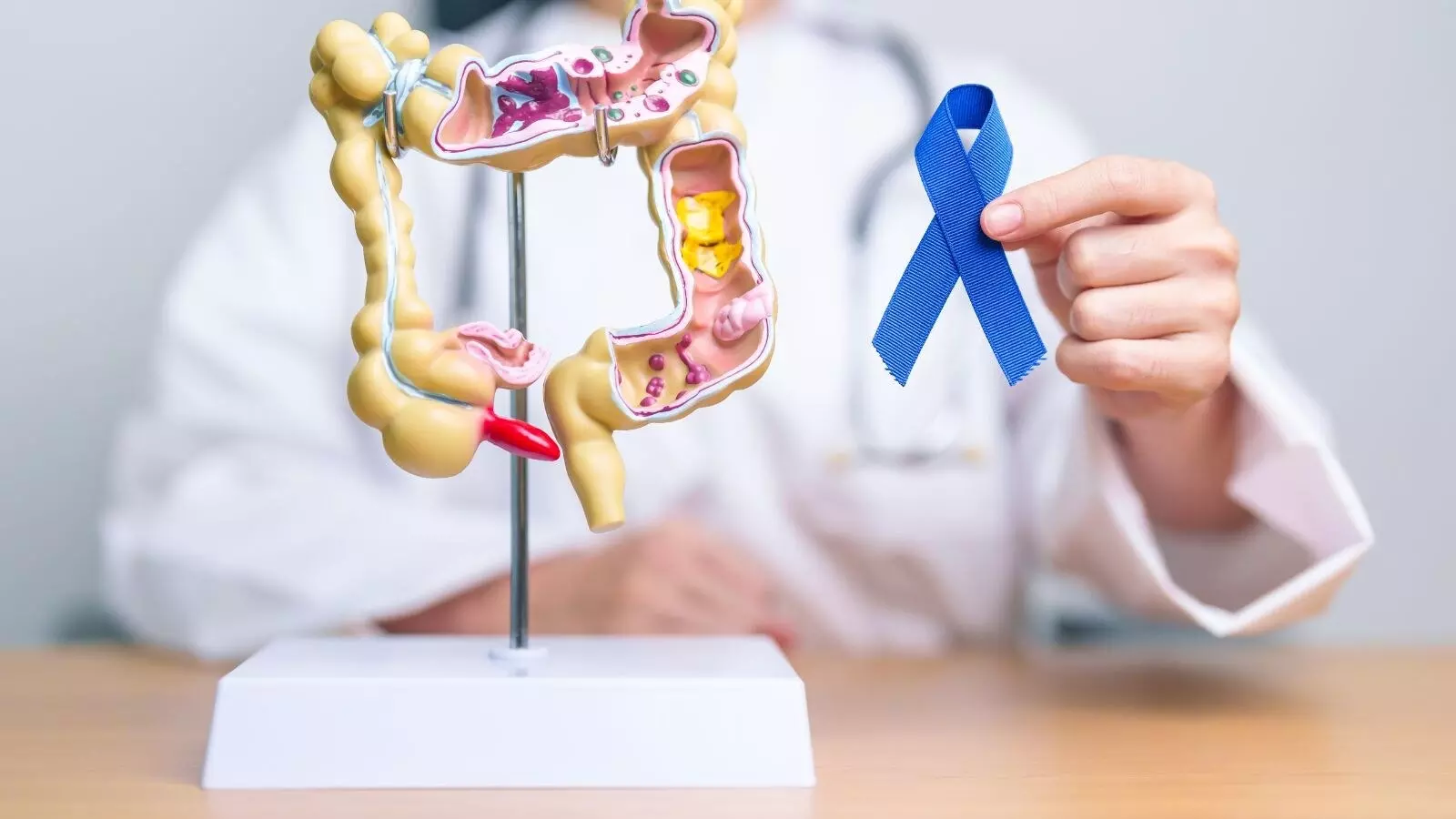 Colon Cancer