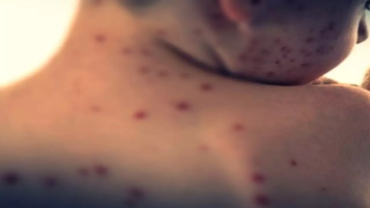 Measles in Mongolia