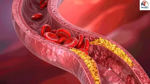 Cholesterol Control Remedies