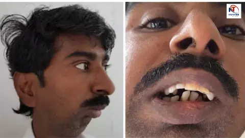 भारत का अपमान! 38 साल से भोजन न कर पाने वाले शख्स की पुरानी फोटो पर नफरत, Pajeet कहकर नौकरी चोर बताया