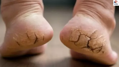 Cracked Heels Remedies Cracked Heels Remedies