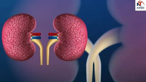 Kidney Failure Symptoms Kidney Failure Symptoms