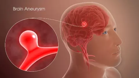 Brain Aneurysm Warning Signs: अचानक असहनीय सिरदर्द? ब्रेन एन्यूरिज़्म हो सकता है जानलेवा