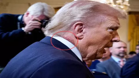 Donald Trump Health Update