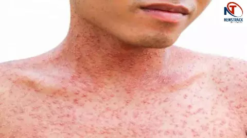 Measles Spread