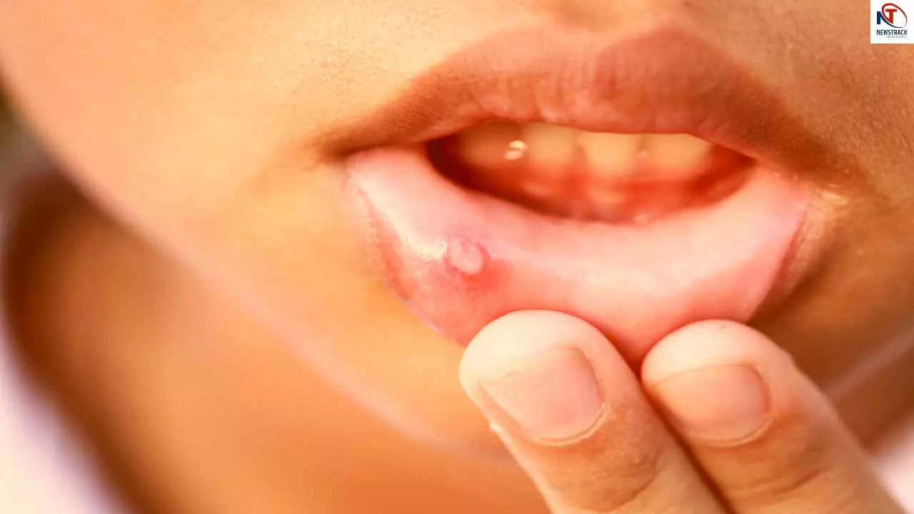Oral Cancer Symptoms