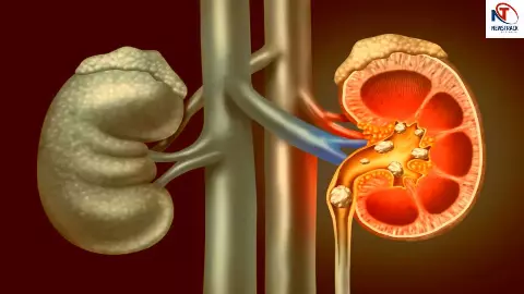 Kidney Care Tips Kidney Care Tips