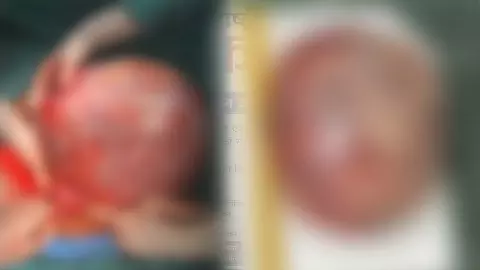 Big success of AIIMS doctors, 7.5 kg cervical tumor removed with successful surgery