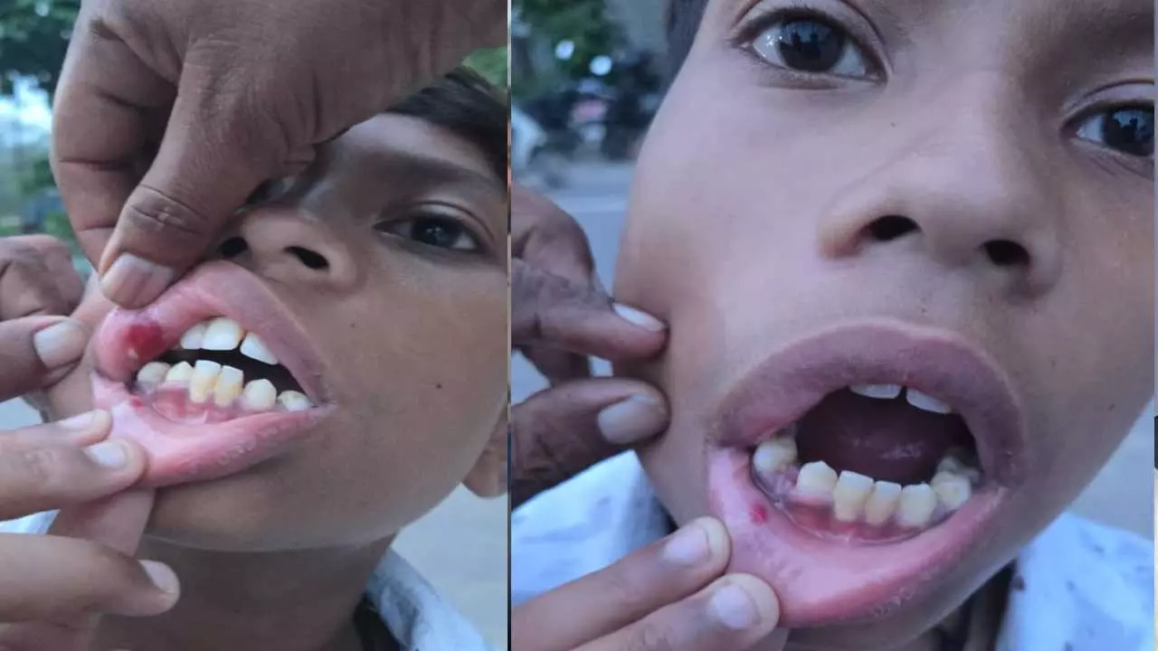 12 साल के छात्र को अलग ले जाकर पीटा? हेड टीचर पर गंभीर आरोप, टूटा बच्चे का दांत; FIR दर्ज